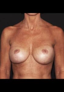 Breast Implant Revision – Case 2