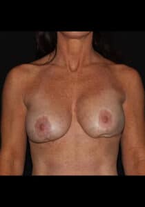 Breast Implant Revision – Case 2