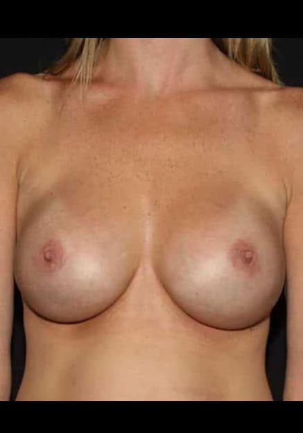Breast Implant Revision – Case 3
