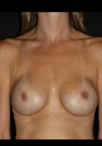 Before Image: Breast Implant Revision – Case 3