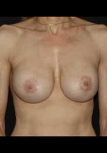 After Image: Breast Implant Revision – Case 4