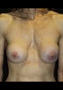 Before Image: Breast Implant Revision – Case 4