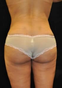 Brazilian Butt Lift – Case 24