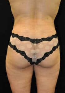 Brazilian Butt Lift – Case 24