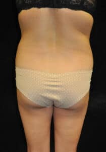 Brazilian Butt Lift – Case 25