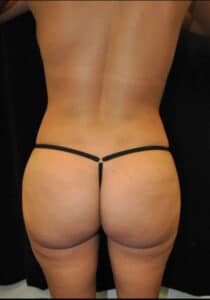 Brazilian Butt Lift – Case 26