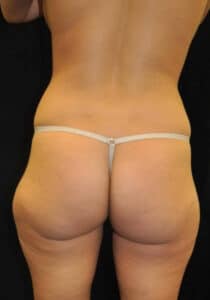 Brazilian Butt Lift – Case 26