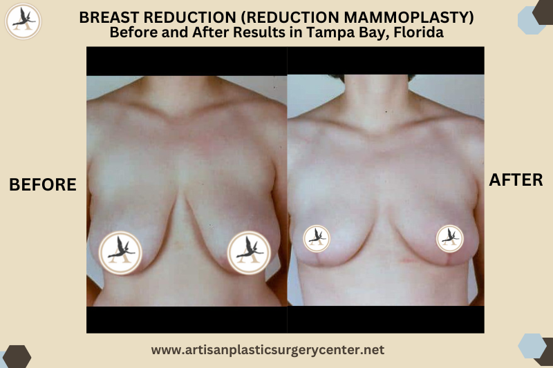 Breast Reduction (Reduction Mammoplasty) Before and After Results in Tampa Bay, Florida