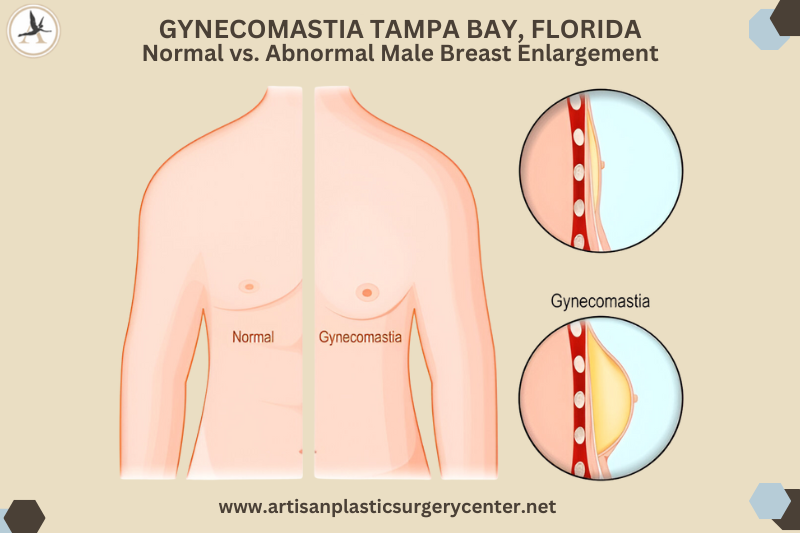 Gynecomastia Tampa Bay, Florida Normal vs. Abnormal Male Breast Enlargement