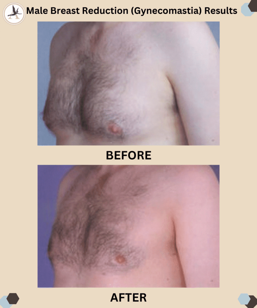 Male Breast Reduction Gynecomastia Surgery in Tampa Bay, Florida_Male Breast Reduction Surgery Benefits - Get Masculinity Back 