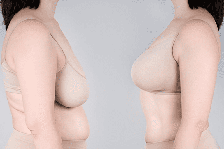 How Soon After Pregnancy Can I Get a Mommy Makeover