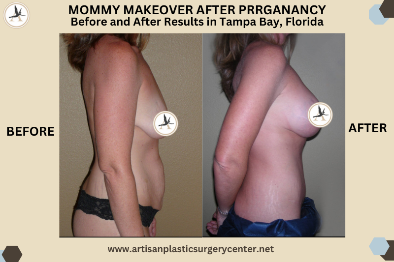 Mommy Makeover After Pregnancy Before and After Results in Tampa, Florida_How Soon After Pregnancy Can I Get a Mommy Makeover