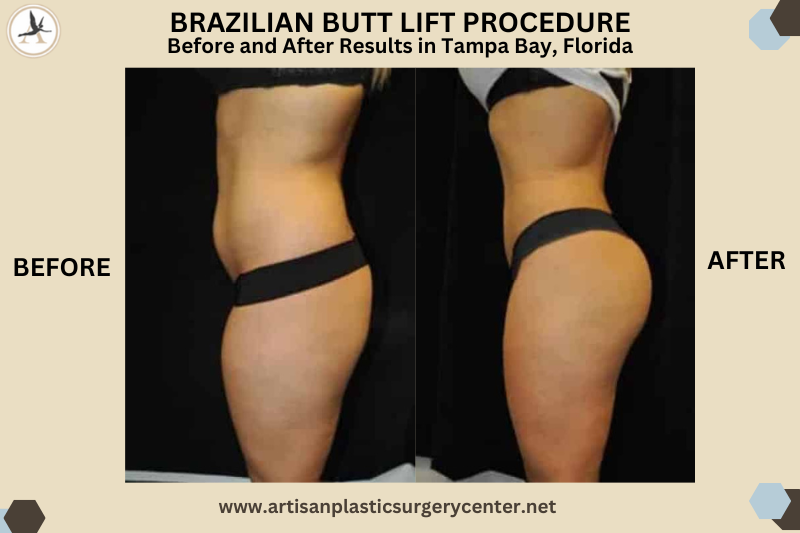 Brazilian Butt Lift Surgery - Before and After Results in Tampa, Florida_How to Make Your Brazilian Butt Lift Recovery Easy Post‑Op Care