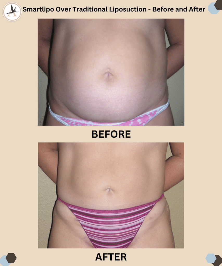 Smartlipo Over Traditional Liposuction_Before and After Results_ - Differences and Benefits