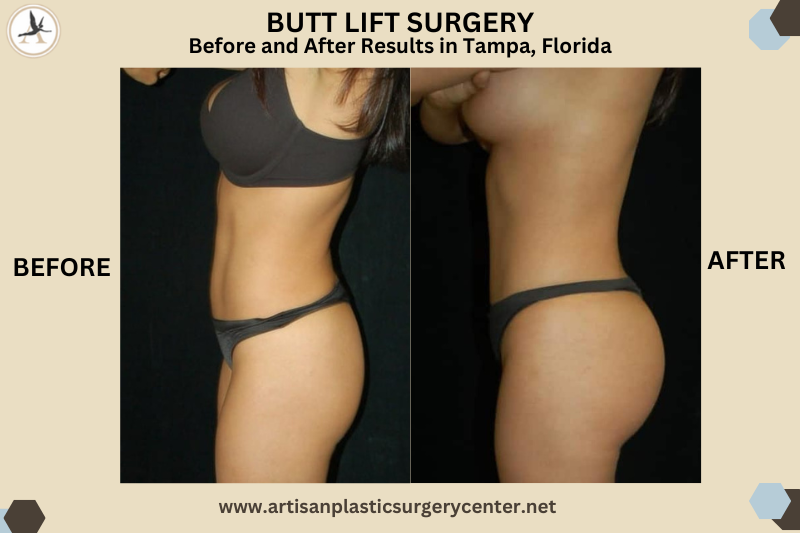 Butt Lift SURGERY Before and After Results in Tampa, Florida_Procedures To Combine With Butt Lift - Reduces Overall Recovery
