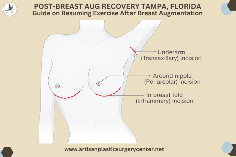 Post-breast aug recovery Tampa, Florida Guide on Resuming Exercise After Breast Augmentation