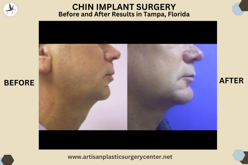 CHIN IMPLANT SURGERY Before and After Results_Improving Your Facial Contour in Tampa Bay, Florida