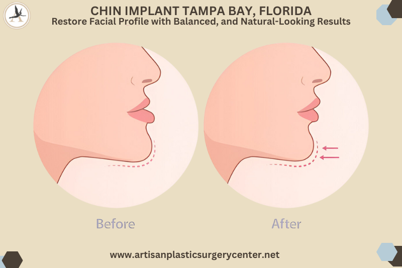 Chin Implant Tampa BAY, Florida Restore Facial Profile with Balanced, and Natural-Looking Results