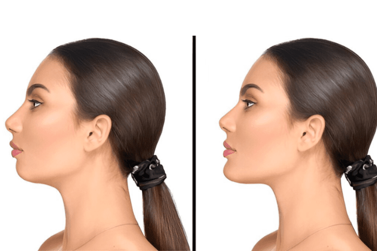 Improving Your Facial Contour With a Chin Implant in Tampa, FL