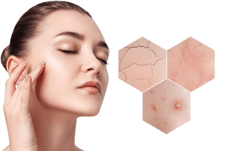 What Is a Chemical Peel and How Does It Help?