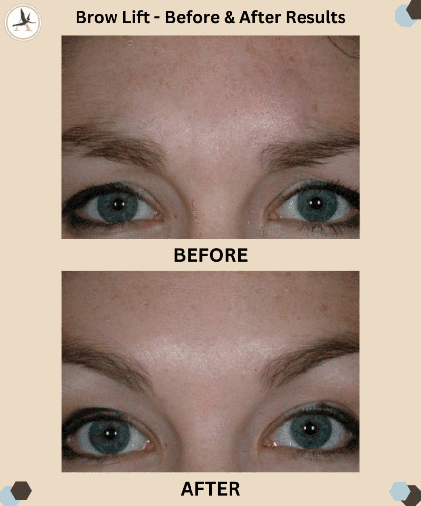 Brow Lift - Before and After Results in Tampa, Florida_Top Benefits of a Brow Lift and When To Consider Getting One
