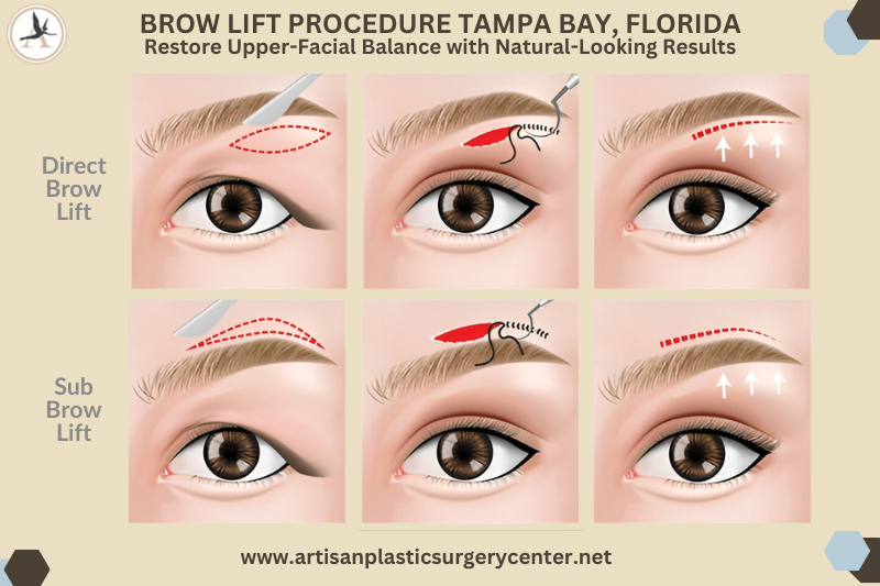 Brow Lift Procedure Tampa BAY, Florida Restore Upper-Facial Balance with Natural-Looking Results