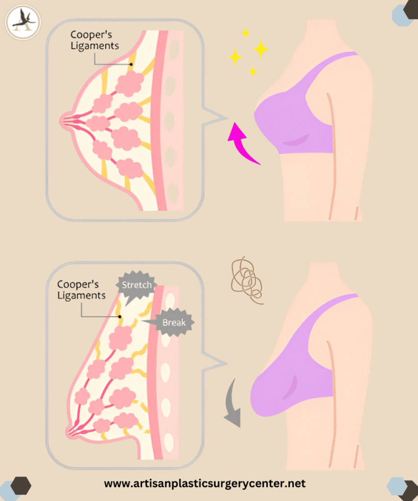 Top Benefits of Getting a Breast Lift - When You Should Consider It in Tampa Bay, Florida