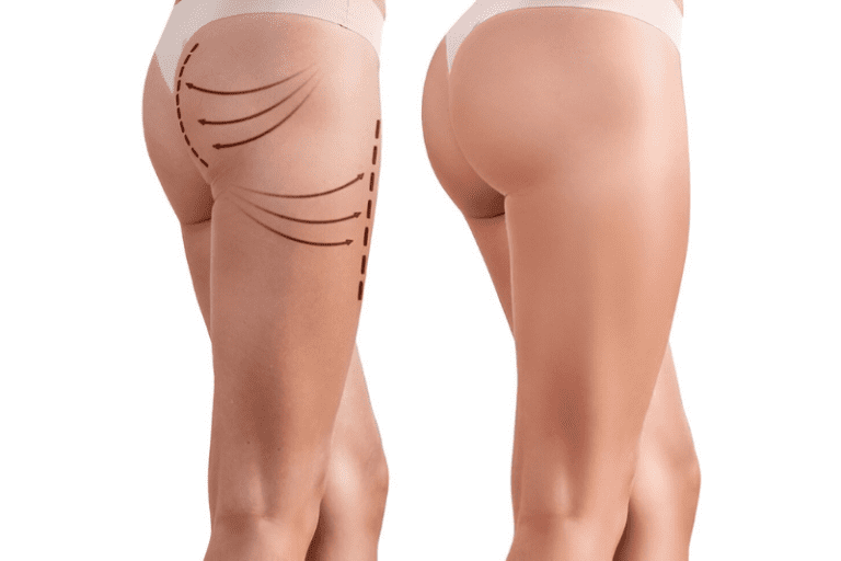 Butt Lift Difference - Brazilian Butt Lift vs Traditional Butt Lift