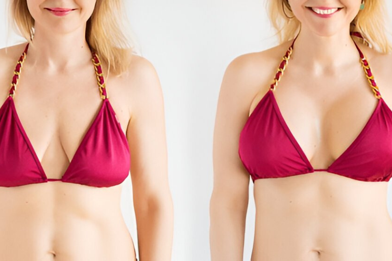 Breast Augmentation in Tampa FL - Materials, Position, Recovery