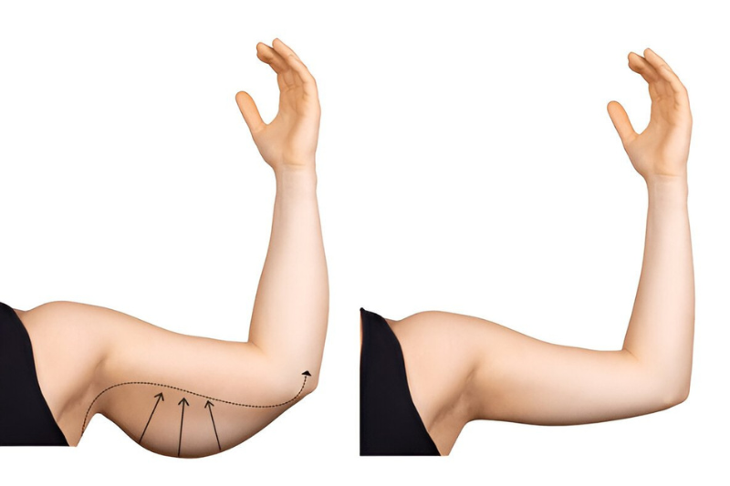 Brachioplasty Surgery in Tampa, FL