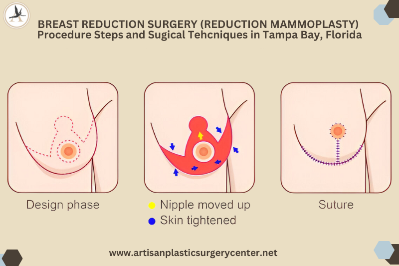 Breast Reduction Surgery (Reduction mammoplasty) Procedure Steps and Sugical Tehcniques in Tampa Bay, Florida