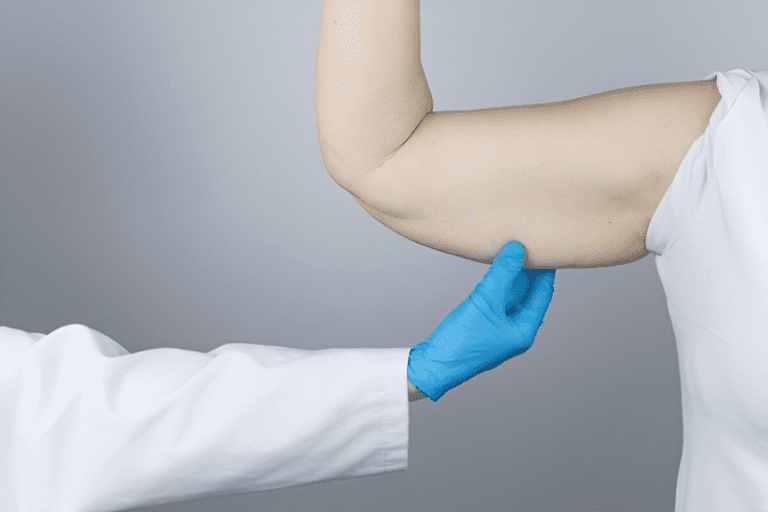 Consider Getting an Upper Arm Lift - Benefits and Ideal Candidates