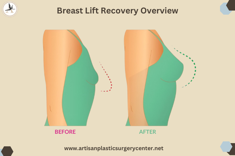 Breast Lift Recovery Guide Overview Infographic