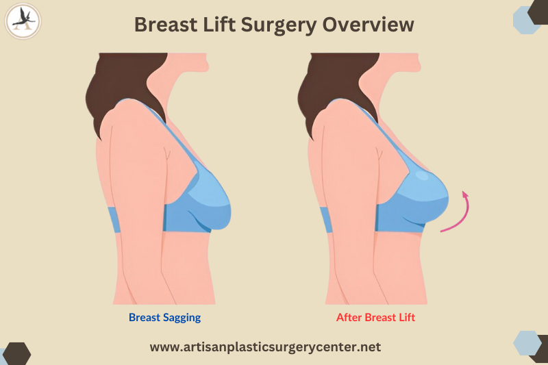 Breast Lift Surgery Overview Infographic