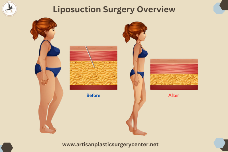 Liposuction Surgery Overview Infographic