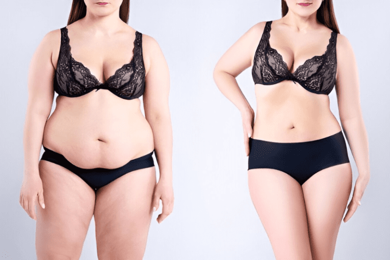 Manage Scarring After Tummy Tuck - Post-surgery Care Guide Tips