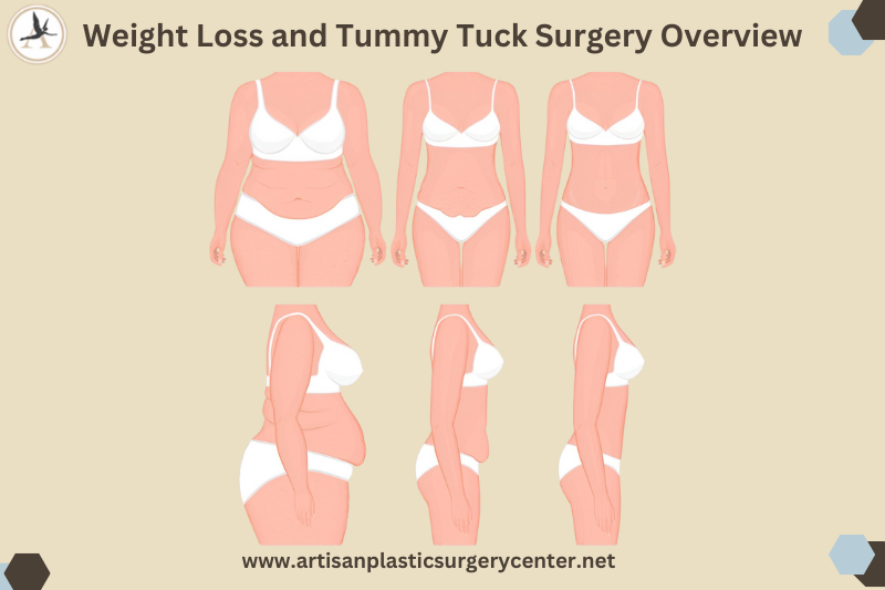 Weight Loss and Tummy Tuck Surgery Overview Infographic
