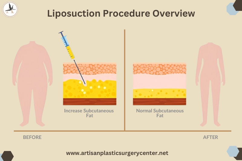 Liposuction Procedure Overview Infographic