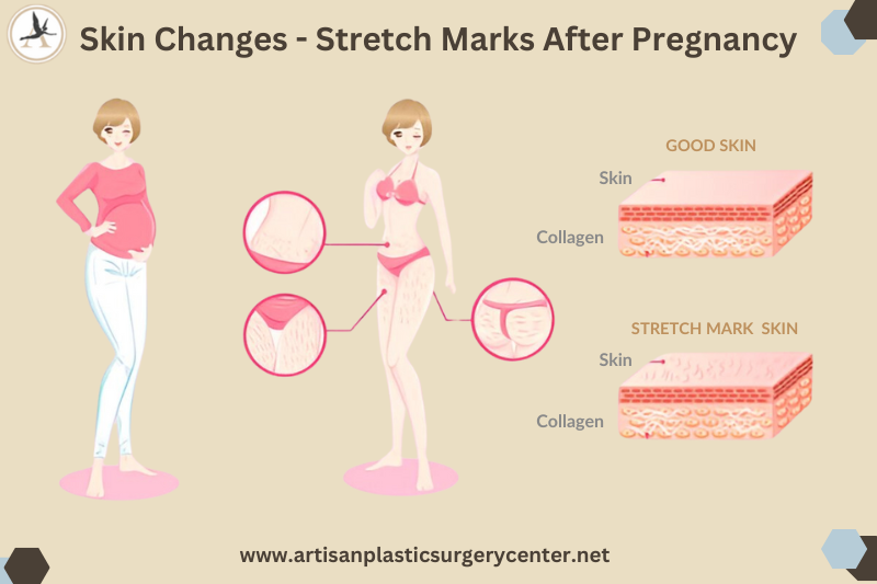 Skin Changes - Stretch Marks After Pregnancy Infographic