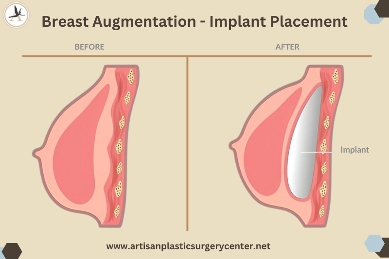 Breast Augmentation - Implant Placement