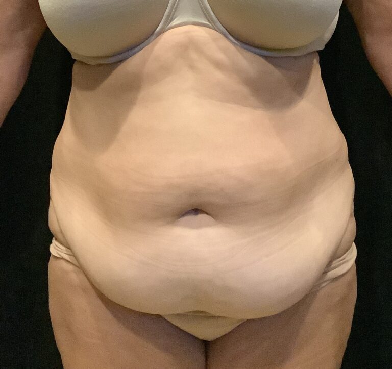 Before Image: Abdominoplasty – Case 19 - front