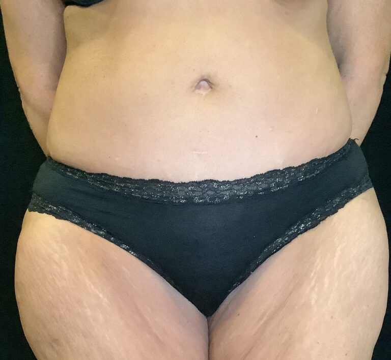 After Image: Abdominoplasty – Case 22 - front