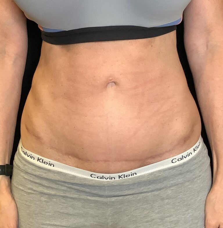 After Image: Abdominoplasty – Case 21 - front
