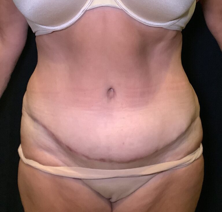 After Image: Abdominoplasty – Case 19 - front