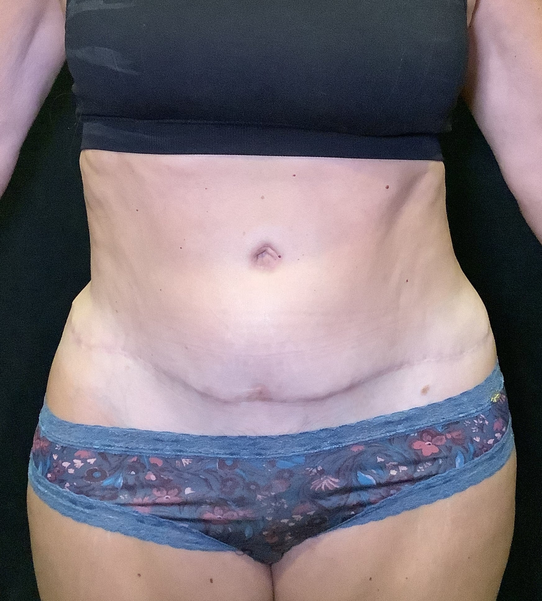 Abdominoplasty – Case 20
