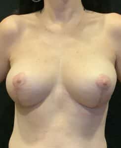 After Image: Breast Implant Removal – Case 5