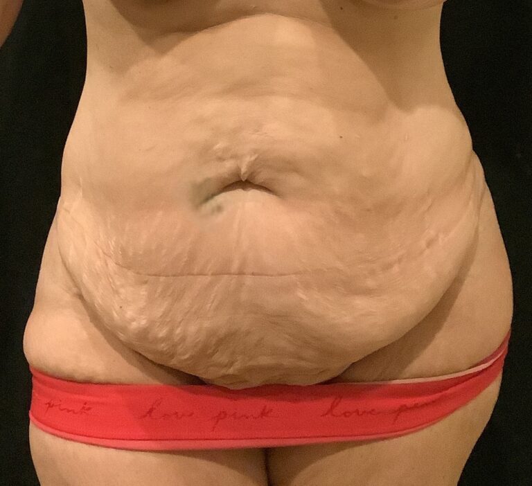Before Image: Abdominoplasty – Case 22 - front