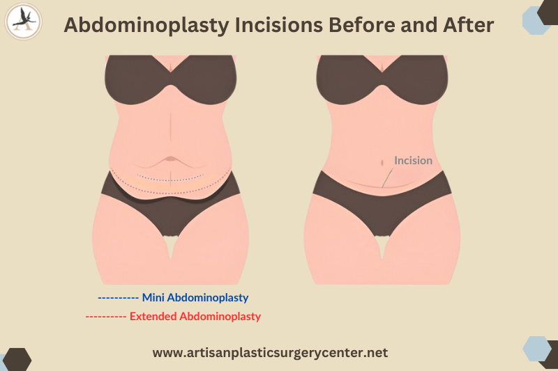 Abdominoplasty Incisions Before and After