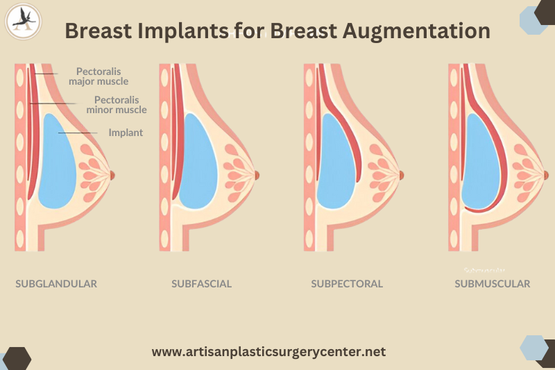 Breast Implants for Breast Augmentation