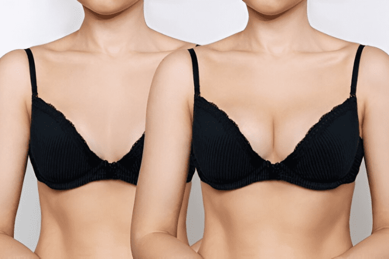 Fat Grafting vs. Implants: Which Looks and Feels More Natural?